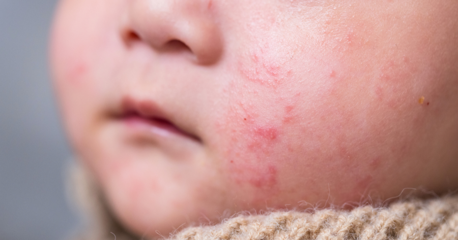 Pediatric Rash Treatment in Fredericksburg, VA