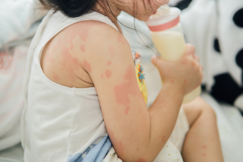 Fungal Infection Treatment in Fredericksburg, VA 