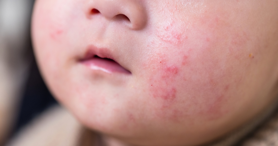 Skin Infection Treatment
