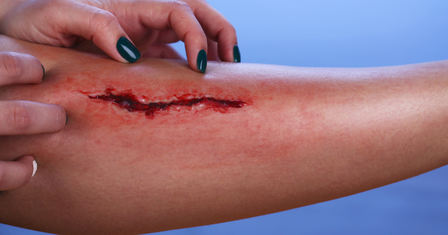 wound-infection-treatment