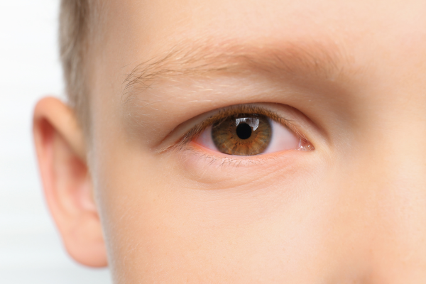 Eye Infections in Children